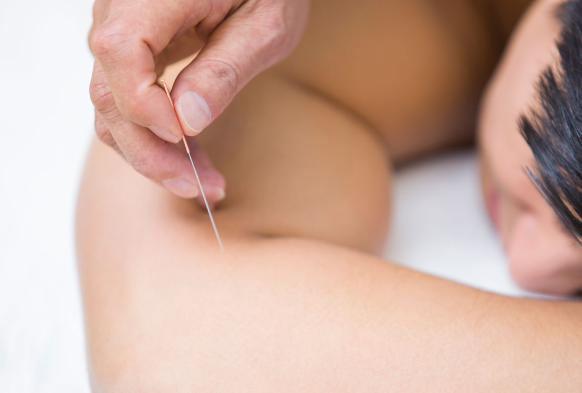 11-acupuntura
